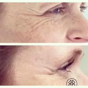 Crows Feet Treatment