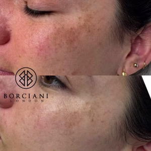 Pigmentation