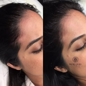 Hair Loss Treatment