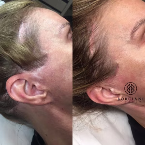 face lift scar camouflage before and after