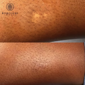 scar camouflage before and after