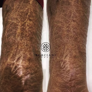 self harm scar before and after