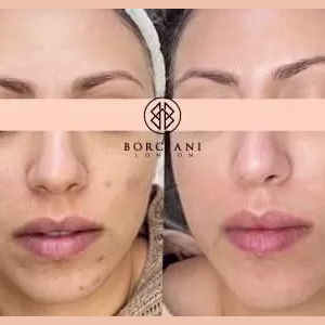 Pigmentation Treatment