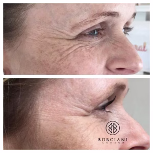 Crows Feet Treatment