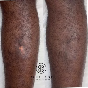 Scar camouflage before and after