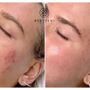Breakouts and pigmentation