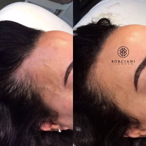 Hair Loss Treatment