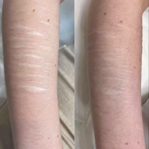 self harm scar before and after