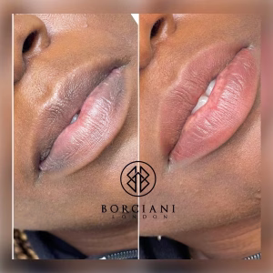 lip neutralisation