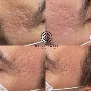 Acne scars before and after CO2