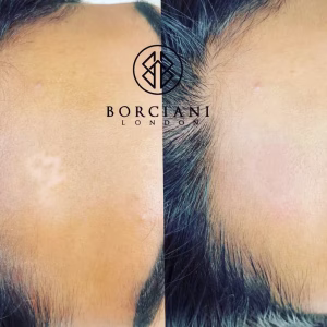 facial scar before and after
