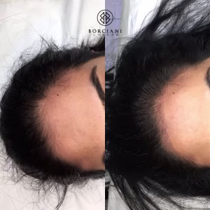 Hair Loss Treatment