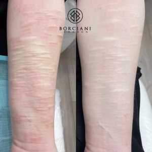self harm scar CO2 before and after