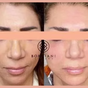 Skin Tightening