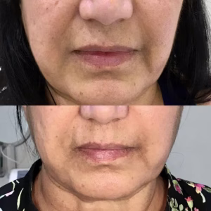 Skin tightening