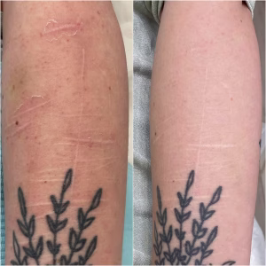 self harm scar before and after Co2