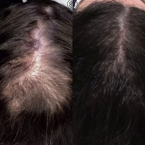 Hair Loss Treatment