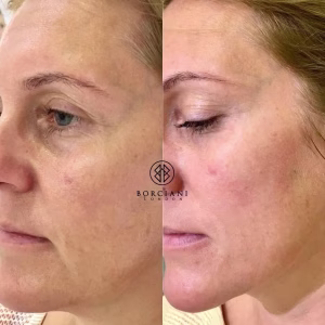 Skin Tightening