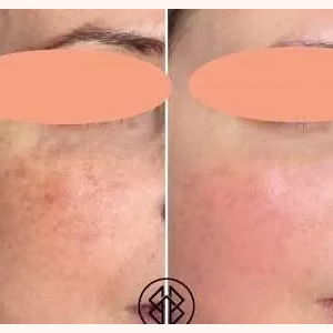 Pigmentation Treatment