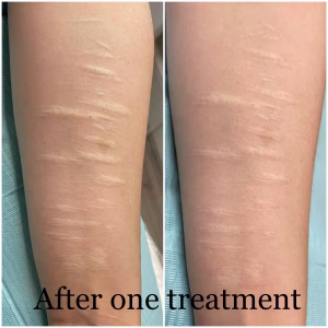 Self harm scar before and after