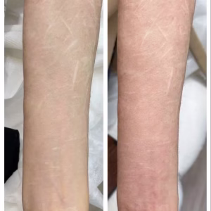 self harm scar before and after