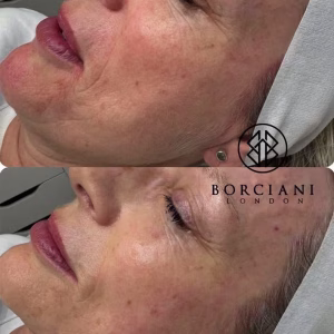 Skin Tightening