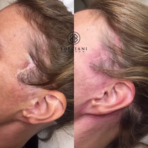 surgical scar camouflage before and after