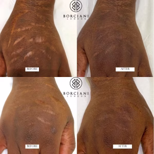 scar camouflage before and after