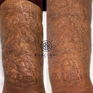 self harm scar before and after