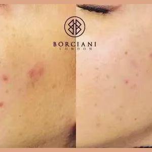Acne Reduction