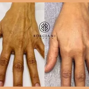 Hand Rejuvenation