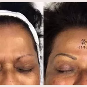 Skin Tightening Forehead
