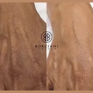 Hand Rejuvenation