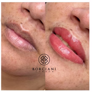 Lip Neutralisation Treatment