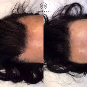 Hair Loss Treatment