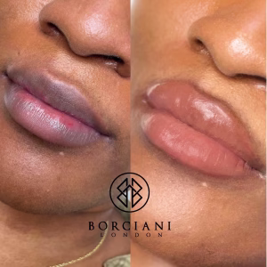 Lip Neutralisation Treatment