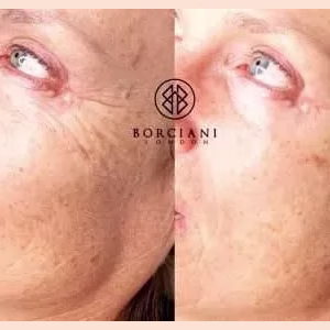 Skin Tightening