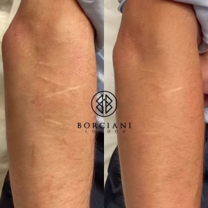 self harm scar before and after