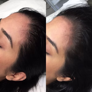 Hair Loss Treatment