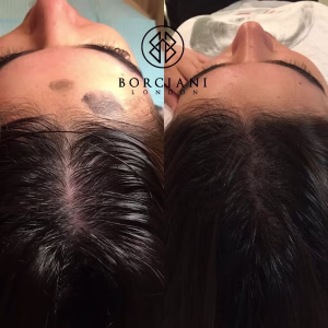 Hair Loss Treatment