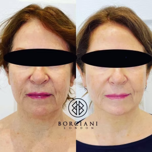Skin Tightening
