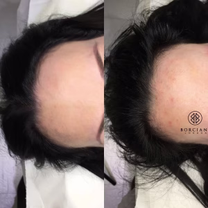 Hair Loss Treatment