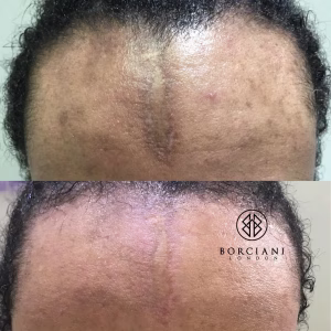 Facial scar pigmentation before and after