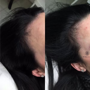 Hair Loss Treatment