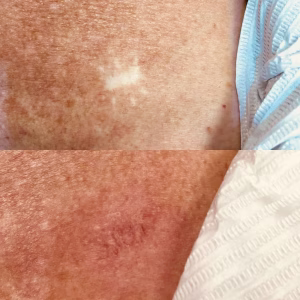 scar camouflage mole before and after