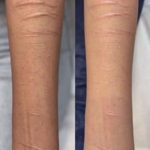 self harm scar before and after