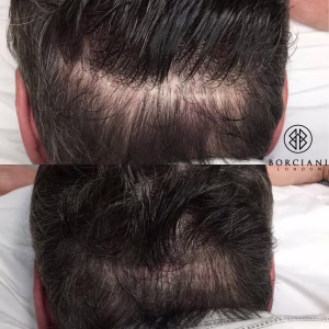 Hair Loss Treatment