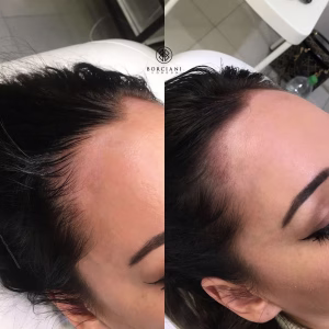 Hair Loss Treatment