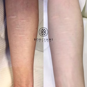 Self harm scar before and after