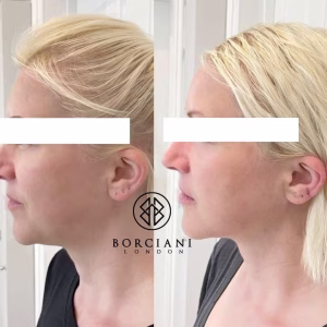 Skin tightening
